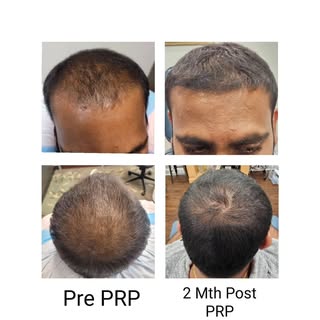 Phoenix Hair Restoration 
PRP Treatments For Hair Loss
Packages starting at $800