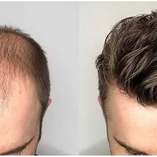 FUE Hair Transplants are 30% Off! Schedule your Free consultation today to see if you're a candidate