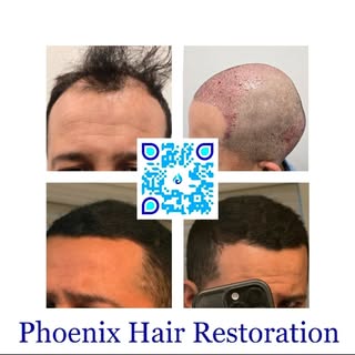 🌟 Ready to transform your look? Discover Phoenix Hair Restoration, where expert care and natural be