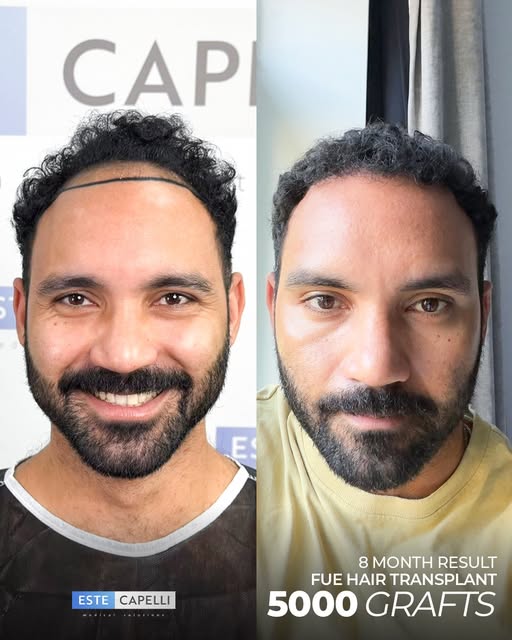 The hair transplant experience for our patient resulted in a truly impressive transformation. Follow