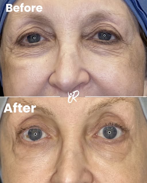 ✨ PRF Under-Eye Rejuvenation by Dr. Nigy ✨

Brighten, refresh, and rejuvenate your under-eyes—natura