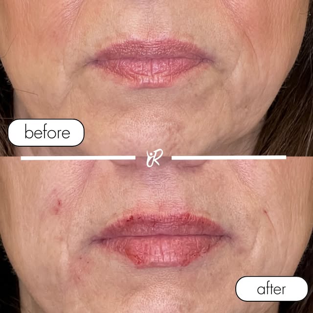 💋 Fall Lip Filler Special with Dr. Nigy! 🍂

Your reminder to give your lips a little extra love th