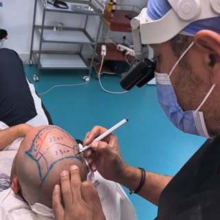La planification du dessin préopératoire est une étape essentielle avant toute greffe capillaire.
Ch