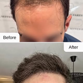 Result at 9 Months.
The anterior two-thirds have been treated, and a second procedure for the vertex