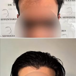 Une greffe ratée, une repousse très faible, une ligne frontale artificielle…
Mais rien n’est irréver