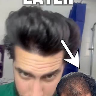Transforming a Diffuse Norwood 5: 3 Years Later

Witness the incredible power of a 3,788 graft hair 