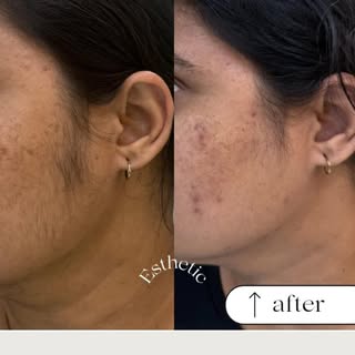 Laser Hair Removal ✳️
With Amazing results 

At 
ESTHETIC 
Skin•Hair•Laser

By
@dr.monica_dhruv⚕️

F