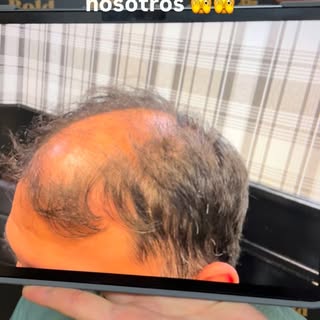 En Bold Hair Restoration te ayudamos a que dejes de perder aura 😎😎 

Agenda tu valoración hoy 📲

