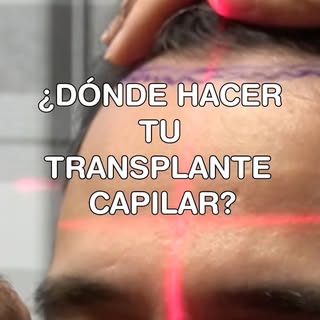 ¿Dónde deberías hacerte tu injerto capilar? 🤔 No es el lugar más barato ni el más lejano, es donde 