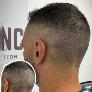 HAIR TRANSPLANT SCAR- BLENDED IN 🖊️

After having a FUE hair transplant our client was left with sc