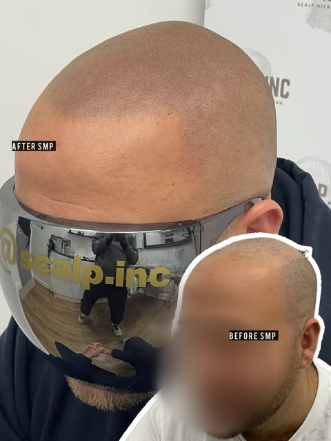 So to cut a long story short our client here went on to have a hair system then found it just looked