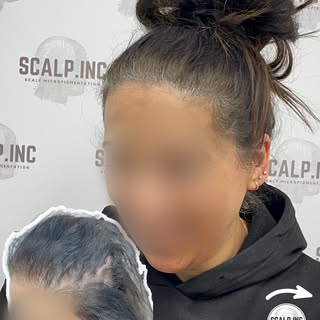 ✨ From years of thinning hair to a fuller-looking scalp in just 3 SMP sessions.

This lovely client 