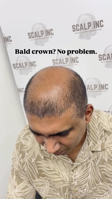 Our client came to us after seeing his brother go through an unsuccessful hair transplant. He wanted