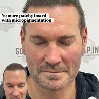 Natural Density ✨

Patchy beard? We’ve got you covered.

Using micropigmentation, we added subtle de