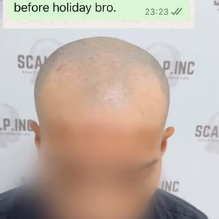 He wanted his hairline back and more density before heading off on holiday with the lads — so he bra