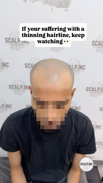 Receding hairline? Thinning crown? We’ve got you! 👊🏼
After just 3 sessions of SMP, our client achi