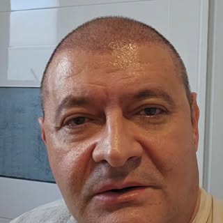 MEU 10° DIA DO PÓS-OPERATÓRIO DE TRANSPLANTE CAPILAR
Hoje fiz mais uma etapa do meu acompanhamento p