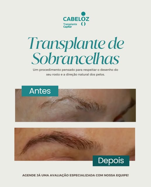 O transplante de sobrancelha vai muito além de preencher falhas.

O objetivo é reconstruir o desenho
