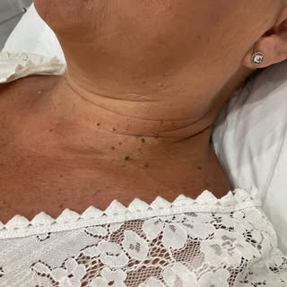 ✨ Plasma Skin Tag Removal with Naomi ✨

10 days healing process from start to finish - Before and af
