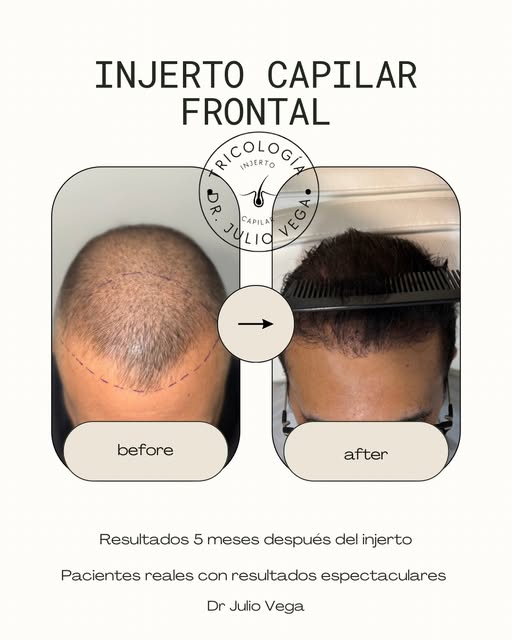5 meses después de un injerto capilar frontal ✨

El crecimiento ya comienza a hacerse evidente. En e