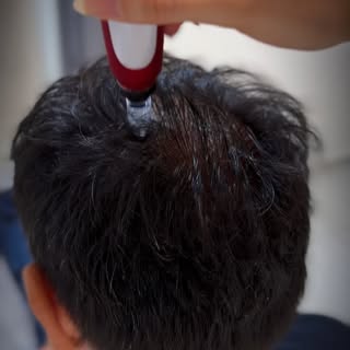 💉 Mesoterapia capilar: tratamiento directo donde tu cabello lo necesita.

La mesoterapia capilar pe