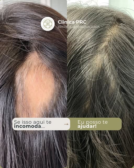 Se algo no seu cabelo tem te incomodado, não precisa simplesmente se acostumar.

Aqui na clinica PRC