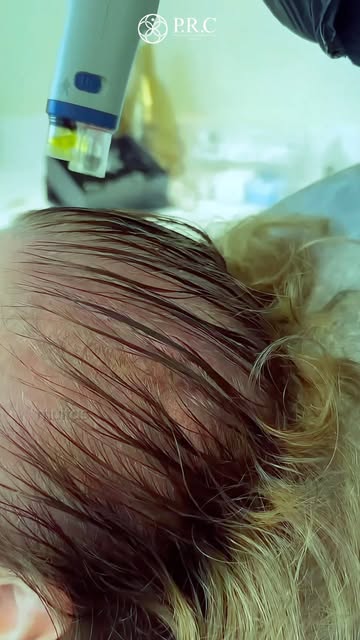 Queda de cabelo não precisa ser intensa para ser um sinal de alerta. ⚠️

Às vezes, os sinais aparece
