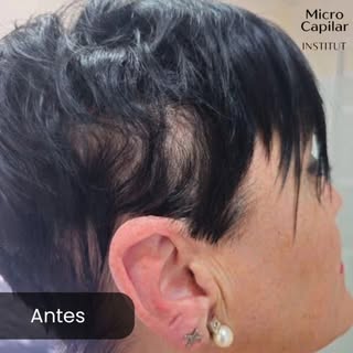 Efecto Densidad, una primera sesión y el cambio ya es notable.

#micropigmentacioncapilar #efecto_de