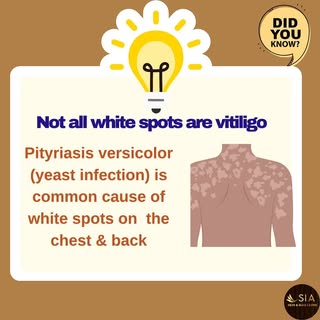 “Not Every White Spot is Vitiligo—Know the Difference.”
.
.
.
.
#SkinHealth #VitiligoAwareness #Derm