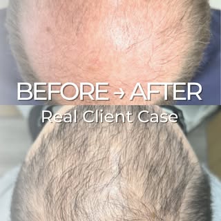 Aneo Botanic TrioCare+ | Real Client Transformation

A natural, non-toxic, results-driven scalp trea