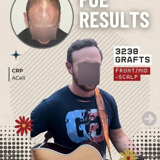 Not all 3,000+ graft cases are the same.

This patient, who started with significant baldness across
