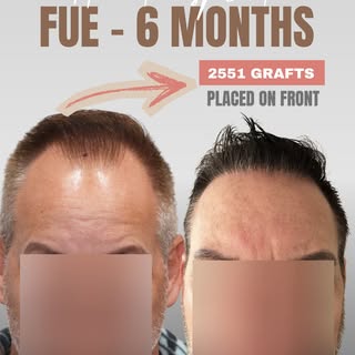 🎥 2,551 grafts. Front only. No crown work.

This patient recently sent in his post-op results after