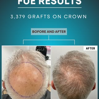 Large crown. Advanced loss.

He came in with a wide, fully exposed crown.
Limited native density. We