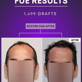 Not every successful hair transplant requires thousands of grafts.

This patient chose a staged FUE 