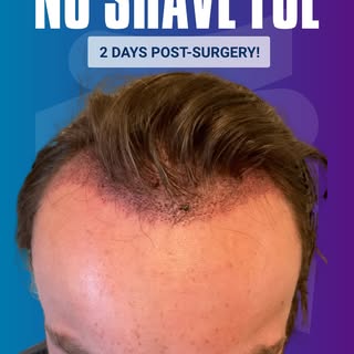 Back to normal in just **2 days.**

This patient chose **No-Shave FUE (C2G®)** with Dr. John P. Cole