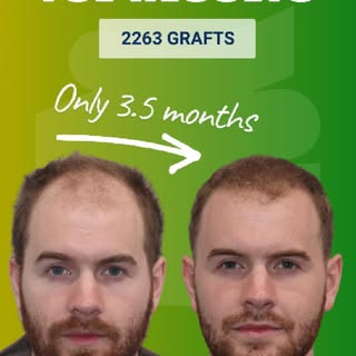 **Just 3½ months after surgery... and the transformation is already underway.**

This patient underw