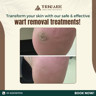 Transform your skin with our safe & effective wart removal treatments!

#Skincare #WartRemoval #Heal