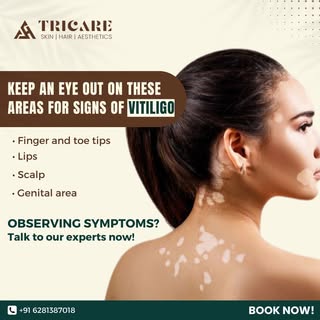 Keep an eye out on these areas for signs of vitiligo-
• Finger and toe tips
• Lips
• Scalp
• Genital