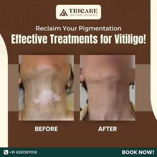 Reclaim Your Pigmentation
Effective Treatments for Vitiligo!

#Vitiligo #SkinCare #ReclaimYourPigmen