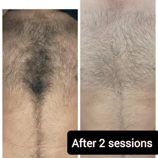 Laser Hair Reduction, one of the most popular procedure is not just for women.... Men do it too... 
