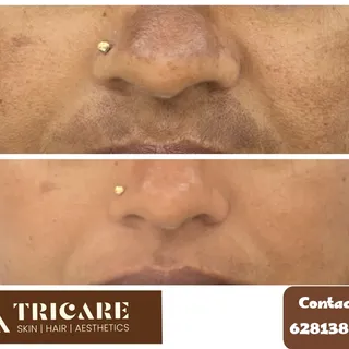 Melasma causes dark patches commonly over cheek, forehead, nose, upper lip . Sun protection is the k
