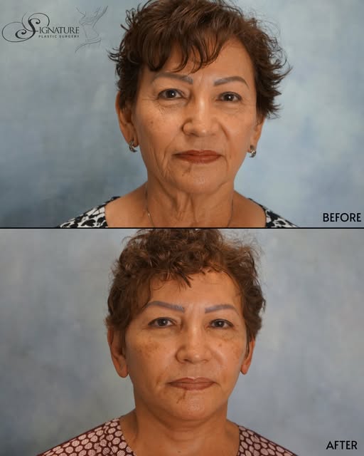 Three weeks post-op. In-office facelift. No general anesthesia. ✦

The results speak for themselves.