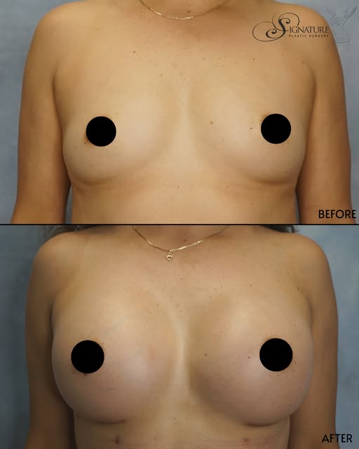 Two months post-op. 550cc silicone breast augmentation with Dr. Shah. ✨

Results like this start wit