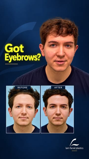 This 27-year old man gives his testimonial after an eyebrow transplant with Dallas hair transplant s