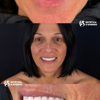 Prima e dopo di una nostra paziente che ha scelto le faccette E-MAX per migliorare forma, colore e a