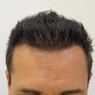 ✨ Trapianto di Capelli – Prima / Dopo ✨

Un risultato straordinario: capelli più folti, naturali e u