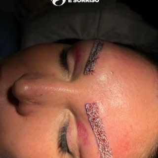 ✨ Trapianto di Sopracciglia

Una procedura avanzata che permette di ricostruire o infoltire le sopra