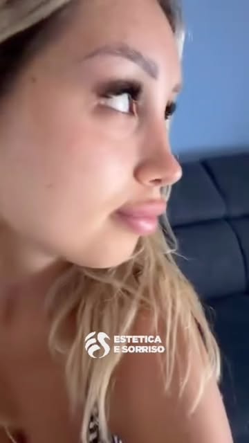 ✨ Una paziente soddisfatta del risultato della sua rinoplastica ✨

Un risultato naturale e armonioso
