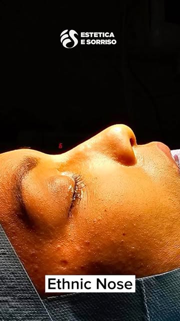 ✨ Ethnic Rhinoplasty – Prima / Dopo ✨

Un intervento personalizzato che tiene conto delle caratteris