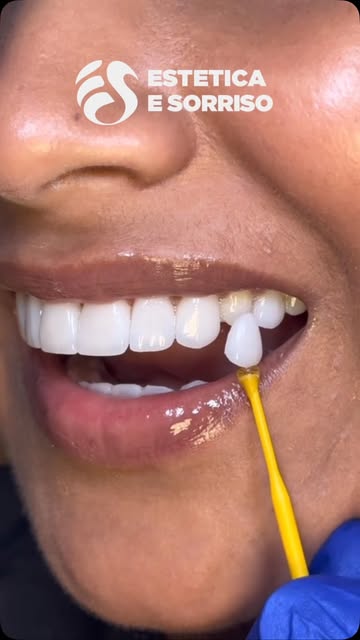 Un sorriso rinnovato attraverso faccette dentali in ceramica E-Max, progettate per migliorare forma,
